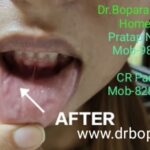 MOUTH ULCER HEALED 2