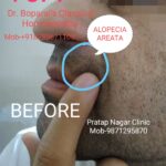 1.ALOPECIA AREATA