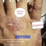 1.ECZEMA HANDS 1