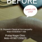 1.GANGLIONIC CYST ON WRIST