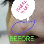 1.NASAL WARTS