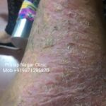 1.PUSTULAR ECZEMA