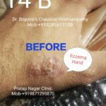 2.ECZEMA