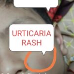 2.URTICARIAL RASH