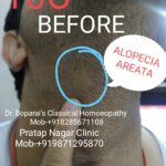 3.ALOPECIA AREATA