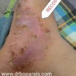 3.ECZEMA FOOT