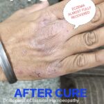 3.ECZEMA HANDS CURED