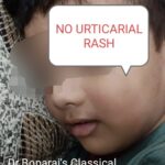 3.URTICARIAL RASHES