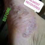 4.PUSTULAR ECZEMA ON FOOT