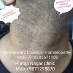 5.ALOPECIA AREATA