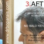 ALOPECIA AREATA AND PATCHY BALDNESS 1